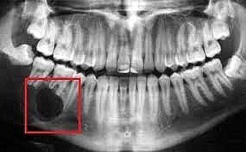 Purulent periodontitis: Causes and treatment