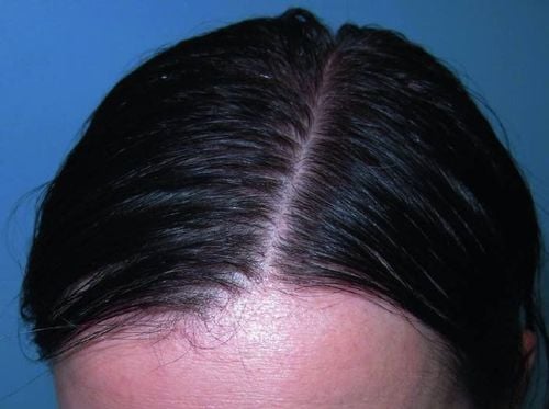 What is Telogen (telogen effluvium) hair loss?