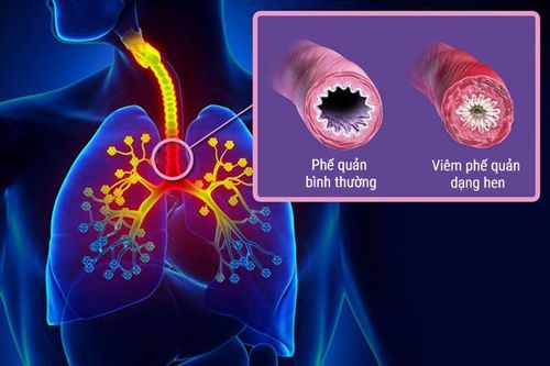 Trẻ bị viêm phế quản dạng hen điều trị như thế nào?