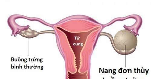 Is a single lobe ovarian cyst dangerous?