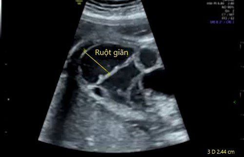 Meconium bowel obstruction in infants is dangerous?