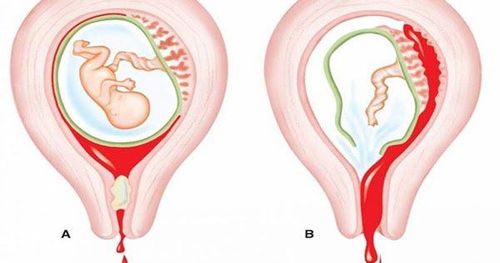 Nguyên nhân có hình ảnh trống âm trong tử cung, không có bào thai chỉ còn sót rau?