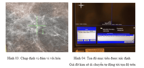 Áp dụng kỹ thuật sinh thiết vú bằng kim có hút chân không hỗ trợ dưới định vị Stereotactic tại Hệ thống Y tế Vinmec
