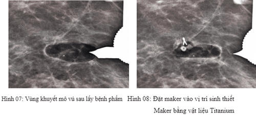 Áp dụng kỹ thuật sinh thiết vú bằng kim có hút chân không hỗ trợ dưới định vị Stereotactic tại Hệ thống Y tế Vinmec