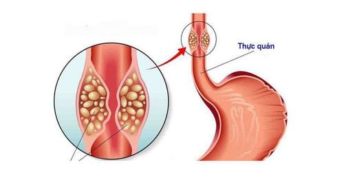 Nguyên nhân và cách điều trị bệnh u niêm dưới thực quản?