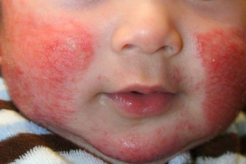 Trẻ 3 tháng tuổi bị viêm da cơ địa và men gan cao có sao không?