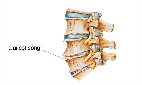 Gai xương đốt xương lưng có gây đau đầu không?