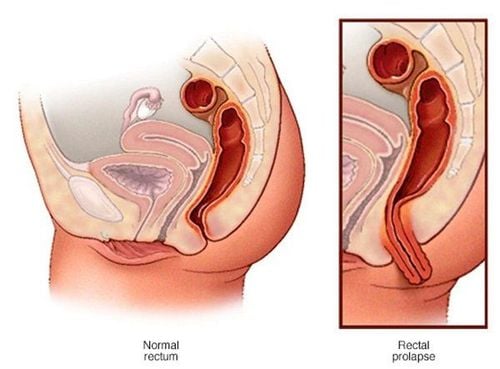 What method is used to diagnose rectal prolapse?