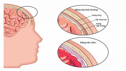 Sốt khi đã điều trị viêm màng não có sao không?