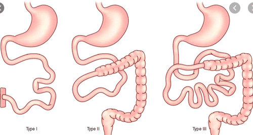 Role of medium-chain fats in patients with short bowel syndrome