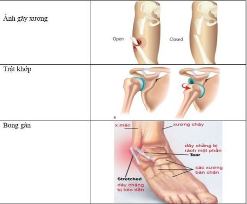 Sơ cứu chấn thương xương, khớp