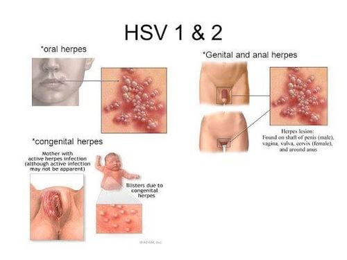 Can Herpes Be Cured?