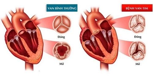 Can 1.5/4 heart valve regurgitation increase physical activity?