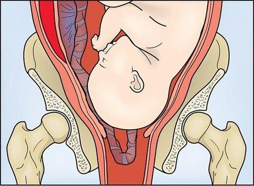 
Nếu tình trạng sa dây rốn nguy hiểm mà không được can thiệp sẽ gây ra các tác hại nghiêm trọng
