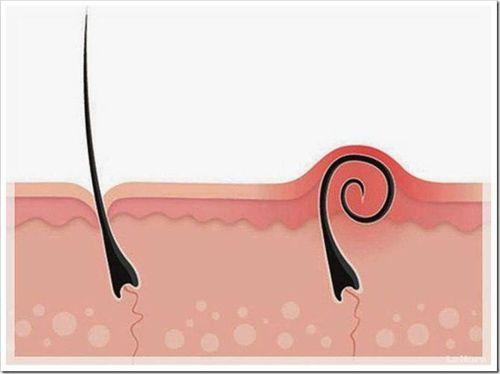 Treatment and prevention of ingrown pubic hair