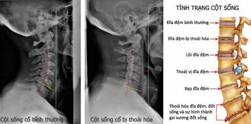 
Quá trình thu hẹp không gian giữa các đốt sống cổ và các rễ thần kinh bị chèn ép được gọi là thoái hóa đĩa đệm cột sống cổ.
