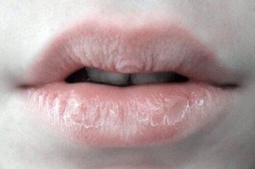 Dry lips all year round are lacking in what substance?