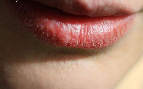 Điều trị viêm môi bong vảy kéo dài như thế nào?