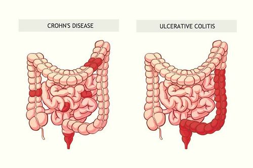 When should a biologic agent be chosen for the treatment of Crohn's disease?