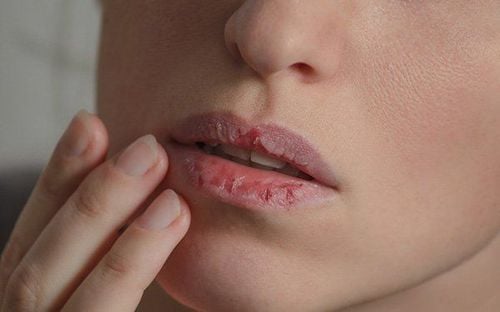 Chapped Lips: When Should You See a Doctor?