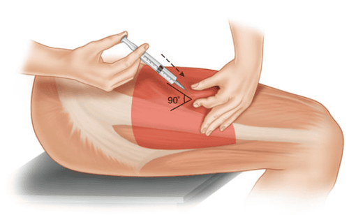 
Người bệnh cần có cơ địa tưới máu tốt để đảm bảo thuốc tiêm bắp hấp thu vào trong cơ.
