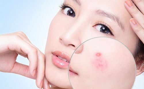 
Nổi mụn trứng cá là một trong những tác dụng phụ phổ biến khi sử dụng thuốc Mekinist.
