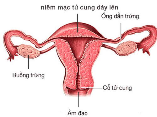 Trễ kinh, nội mạc tử cung dày chưa thấy túi thai có phải có thai không?