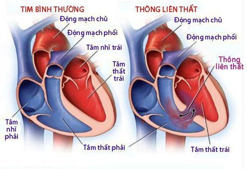 Điều trị thông liên thất khi 68 tuổi thế nào?