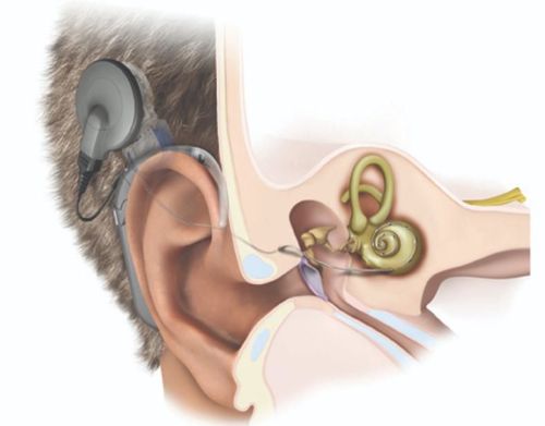 Cochlear implants: Another kind of "hearing"