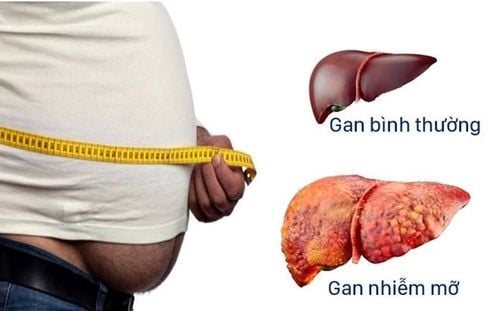 
Khi bị gan nhiễm mỡ, hầu như bệnh nhân sẽ không phát hiện ra mình bị bệnh
