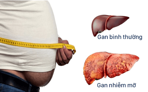 
Tình trạng béo phì liên quan đến bệnh gan nhiễm mỡ với mức độ nghiêm trọng của COVID-19
