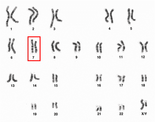 Chromosome 7, Partial Monosomy 7p: Những điều cần biết