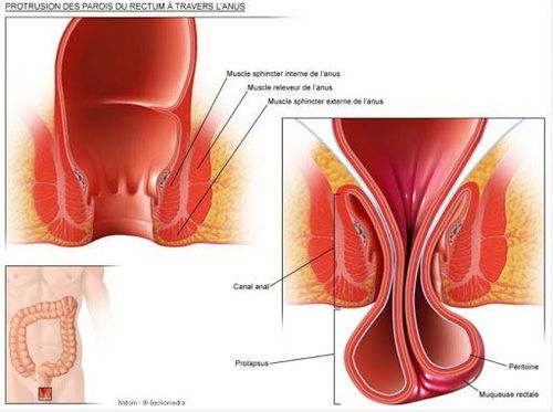 What to do if urinating does not go away with anal prolapse?