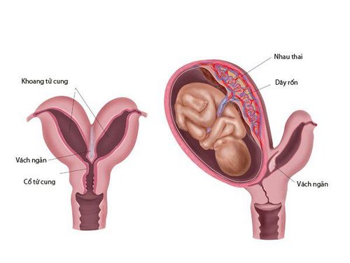 Tử cung hai sừng có nguy hiểm không?