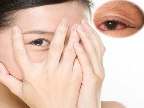Mắt đỏ và nhức là dấu hiệu của bệnh gì?