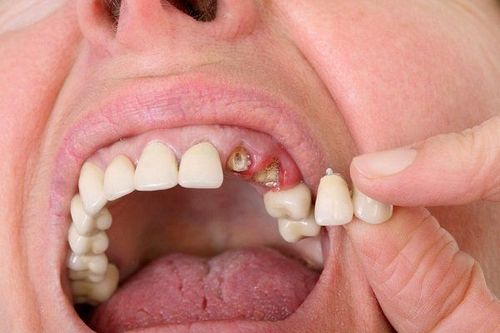 Điều trị sâu răng chỉ còn chân răng như thế nào?