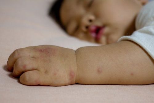 Trẻ 14 tháng tuổi bị sốt lại có phải biến chứng của bệnh tay chân miệng không?
