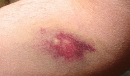 Tiểu cầu giảm, xuất hiện vết bầm tím ở chân có nguy hiểm không?