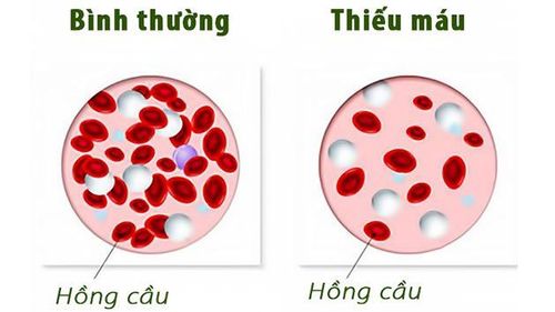 Người bị thiếu máu có thể làm điện di Hb được không?