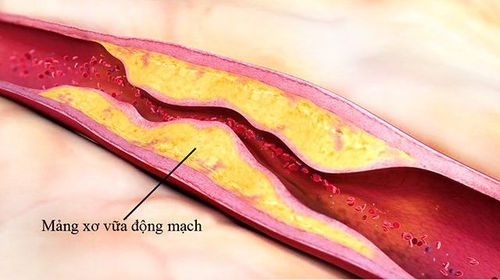 Xơ cứng động mạch hay xơ vữa động mạch?