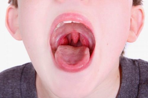 Excessive tonsils with sleep apnea syndrome