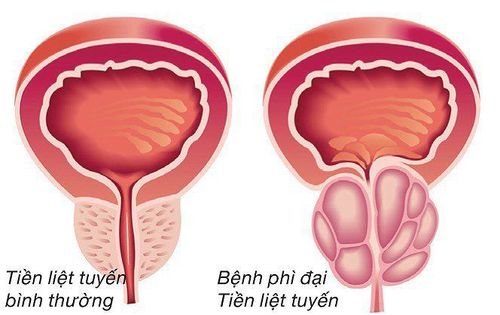 Common symptoms of an enlarged prostate