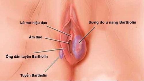 
Khi u nang tuyến Bartholin lớn hoặc nhiễm trùng, bạn có thể sẽ bị đau tại vị trí của u nang.
