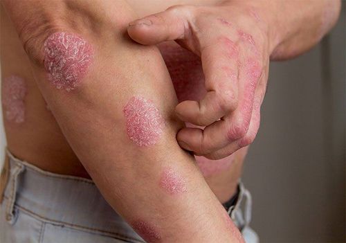 Is a Psoriasis Detox Diet Effective?