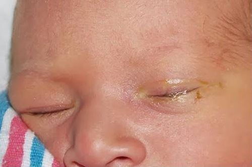 Trẻ sơ sinh ra nhiều gỉ mắt có sao không?