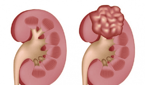 Secondary renal cysts