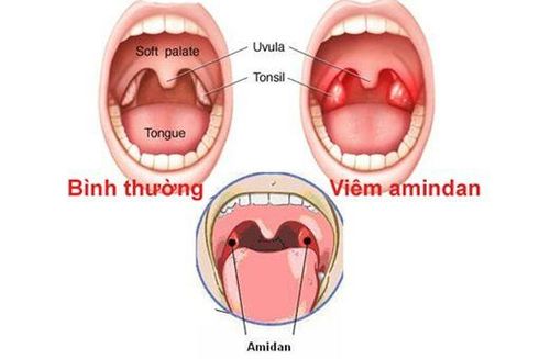 Xuất hiện hạch góc hàm sau khi cắt amidan có nên sinh thiết không?