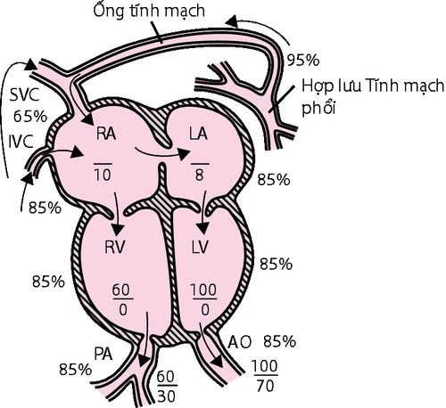 Complete return of pulmonary venous abnormalities