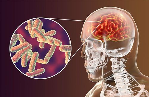 Tuberculosis is what disease? Signs and causes