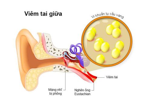 Labyrinthitis dangerous?